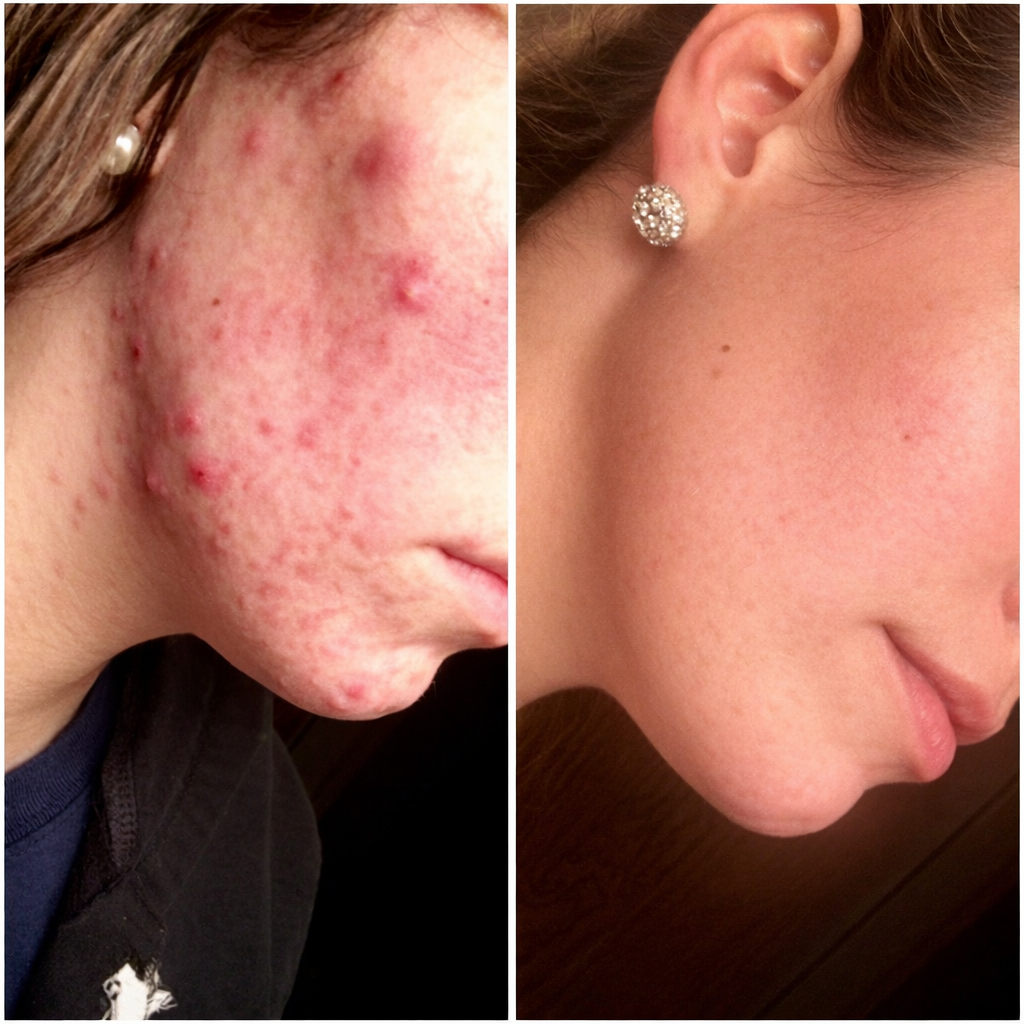 Youth Revival Ritual™ High Frequency Wand